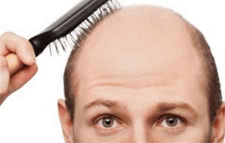 秃头是什么原因造成的 怎么预防秃头