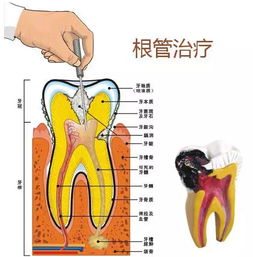 口腔根管治疗毕业论文