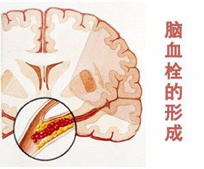 脑血栓吃什么食物最好 脑血栓患者不能吃什么？ 