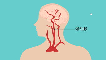 颈动脉有斑块科普视频 权威专家视频解读 健康一线 