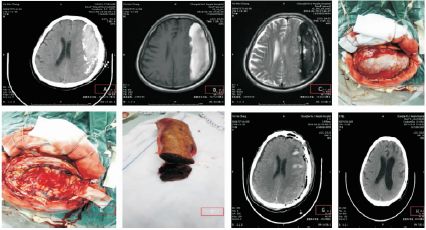 机化型慢性硬膜下血肿的手术治疗 