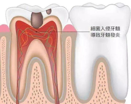 我只想补个牙,医生却让我做根管治疗