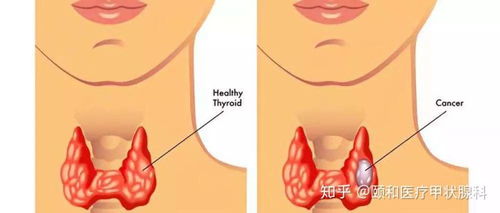 甲状腺出了问题,是吃不加碘盐呢,还是加碘盐