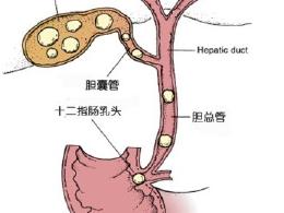 胆管癌能自愈吗 胆管癌的治愈率高吗 胆管癌能根治吗 胆管癌能治好吗 