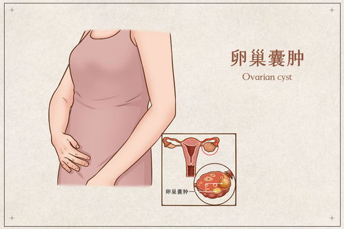 超声解读 卵巢囊肿到底需不需要手术