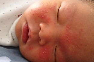 婴儿过敏长湿疹怎么治疗