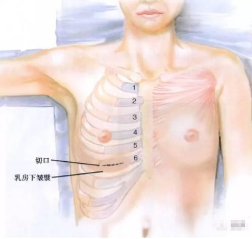 肋软骨综合隆鼻,对人体的健康存在影响吗 