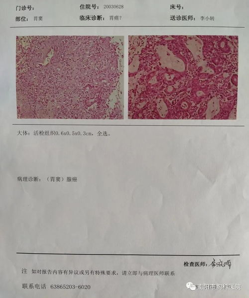 腹腔镜胃窦癌根治术 