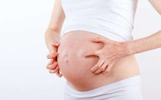 孕妇得荨麻疹该注意什么呢 