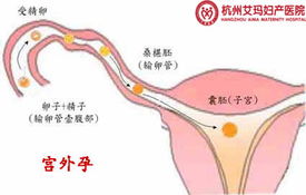 宫外孕手术图片 信息图文欣赏 信息村 K0w0m Com