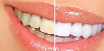什么东西能让牙齿快速变白,什么东西可以把牙齿洗白,吃什么东西牙齿变白