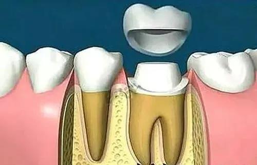 为什么做完根管治疗后,医生还要我做牙冠啊 