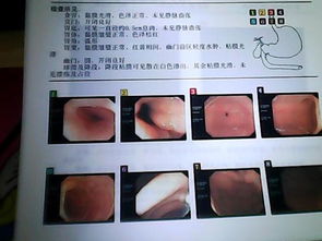 请问做胃息肉0.5毫米手术需要住院吗 费用需要6 7千元吗 重庆地区