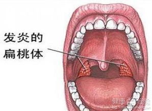 得了急性扁桃体炎，是急性化脓性扁桃体炎,呼吸困难,要输液吗