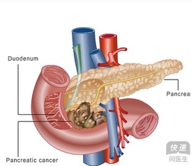 晚期胰腺癌放化疗有用吗(胰腺癌晚期化疗可以延长寿命吗)
