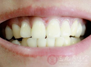 牙齿种植的过程是什么 牙齿种植需要注意这些