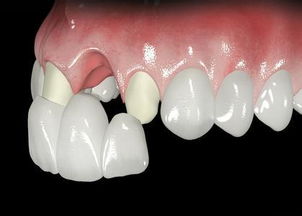 活动假牙 装一个活动假牙 与镶牙有什么区别
