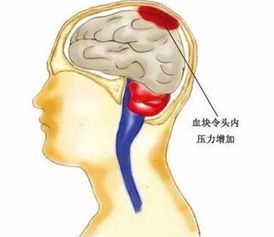 惊醒,脑血管崩溃前有10大征兆,绝大部分人都忽略了 