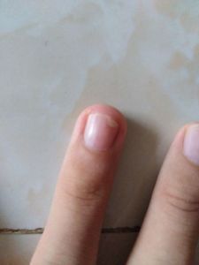 手指甲被压后指甲盖和肉分离的那部分要不要剪掉