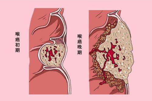 咽喉不适,为何会查出2种癌 亲身经历给你提个醒,别忽视小毛病