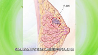 蔡霹雳讲八字 28岁就得乳癌,请重视剖腹生产