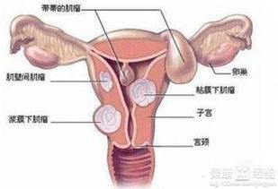 子宫肌瘤多大需要切除