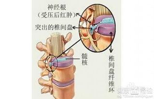 跪求，得了股质增生，衣食住行应该注意些什么？