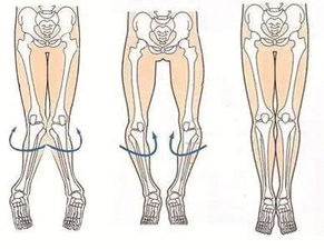 o型腿怎么矫正？如何矫正罗圈腿