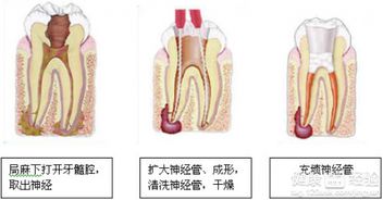 牙髓炎必须根管治疗吗