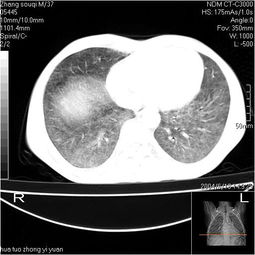 肺部病变 CT