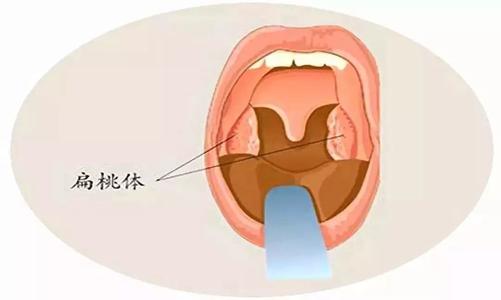 扁桃体发炎,咽喉肿痛,针对这种常见疾病,应该如何应对才好