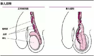 右睾丸胀痛是什么原因