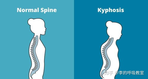 驼背和脊柱侧弯的区别在哪儿 纠正方法有什么不一样吗 