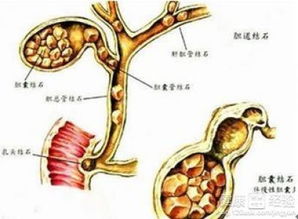 胆结石需要注意什么