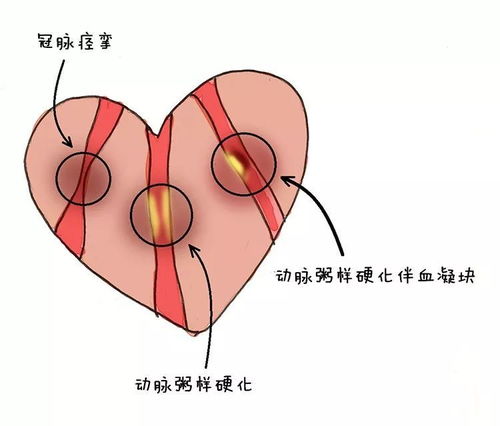 心肌缺血会导致死人吗有什么依据吗