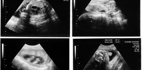未见胚芽 怀孕两个月照B超,未见胚芽怎么回事呢