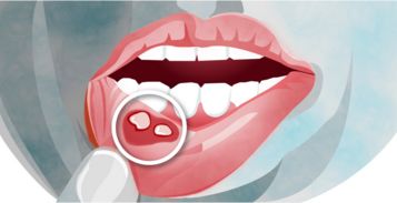 口腔溃疡长时间不好，是癌症前兆吗