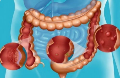 准备做肠胃息肉手术的你,了解过术后需要注意哪些不适和异常吗