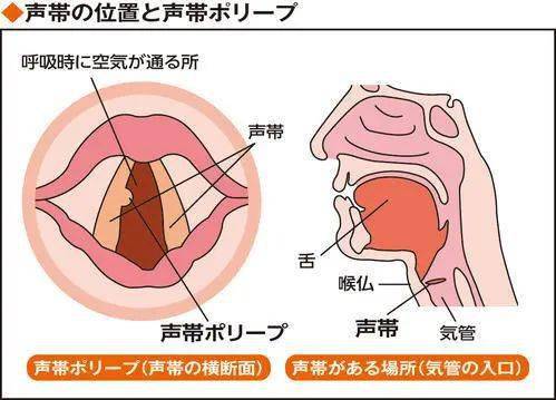 宝宝声音嘶哑 小心声带息肉