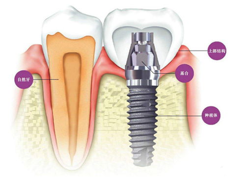 杭州种植牙为什么这么贵 三分钟带你了解种牙真实费用