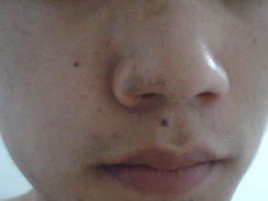 男生为什么鼻子上也会有黑斑,要怎么去处理 求救 