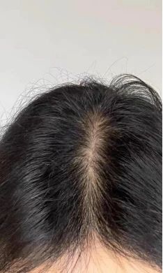 发缝宽头顶稀疏怎么办 育发生发的问题都交给育发液