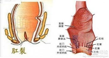 治疗肛裂的最好办法