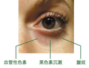 黑眼圈类型 成因及不同类型治疗方式