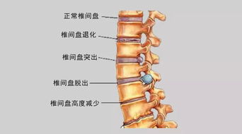 腰痛麻痹,中医艾灸治腰椎有奇效