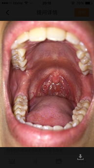 喉咙里有泡泡是什么东西