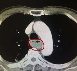 肺部CT检查,只能检查肺吗 其实,肺部CT还可以发现很多其他问题