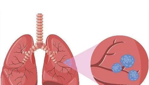 肺部健康很重要,这几点,或许可以预防肺结节病变,保护肺部健康