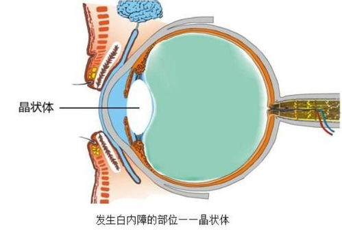 七旬老太高度近视兼白内障,手术治疗风险极高 只能等 失明