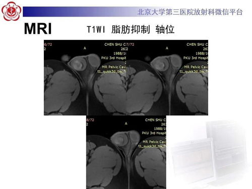 30岁男性,右侧睾丸有肿物,无明显疼痛